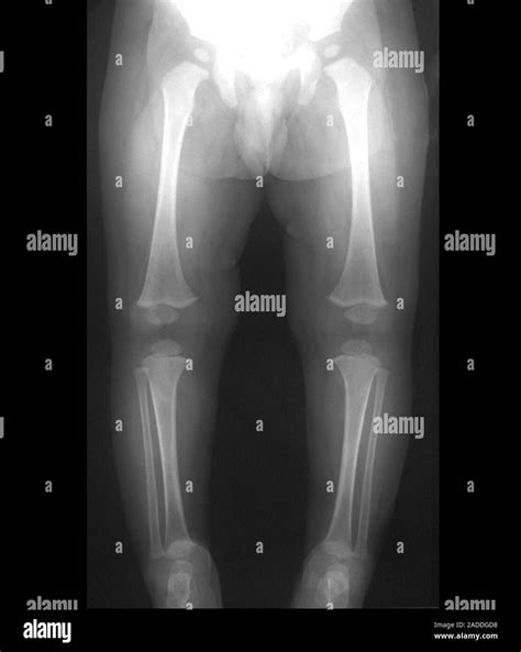 Leg bones of 18-month-old infant, frontal X-ray. This X-ray shows the ...