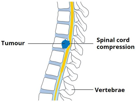 Spinal Cord Compression 的图像结果