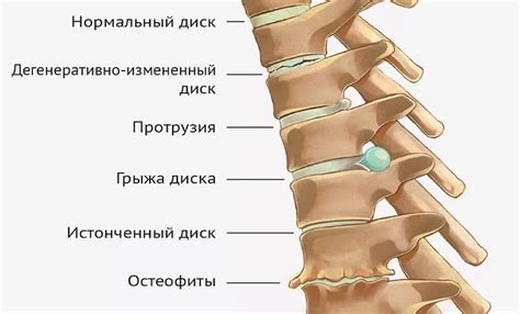 Остеохондроз позвоночника: причины, симптомы, стадии, лечение, профилактика