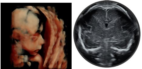 Antenatal Ultrasound Services