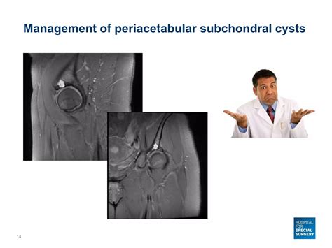 Bone Marrow Lesions of the Hip - Avascular Necrosis and Subchondral ...