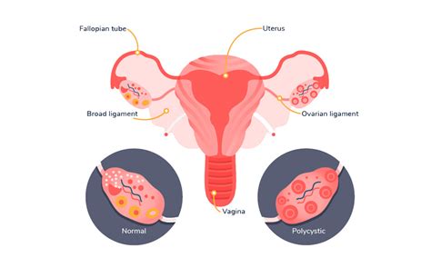 PCOS & Sugar: How Switching To Stevia Will Help! – Magicleaf