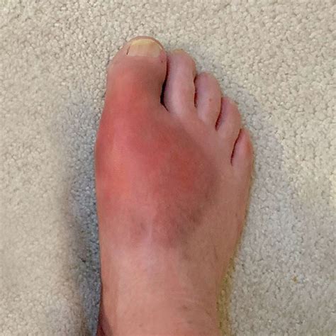 Primary Gout in a 6-Year-Old Girl Presenting as a Foot Mass: A Case Report