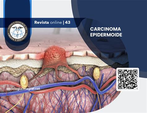 Carcinoma Epidermoide – Clínica Integral de Cirugía y Oncología