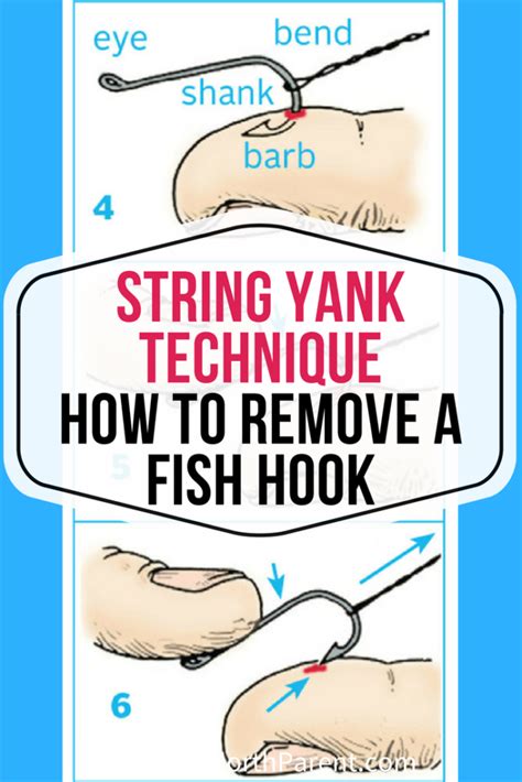 Image result for String Pull Method Fish Hook Removal