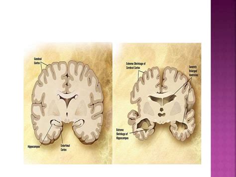 Image result for Neocortex Disorders