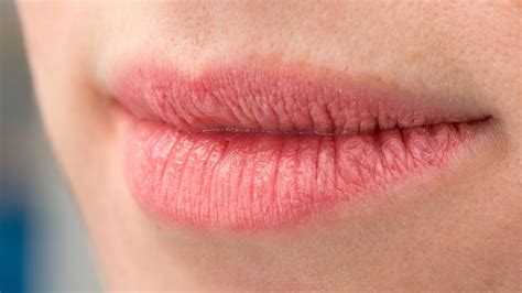 Image result for Pimple From Dry Lips