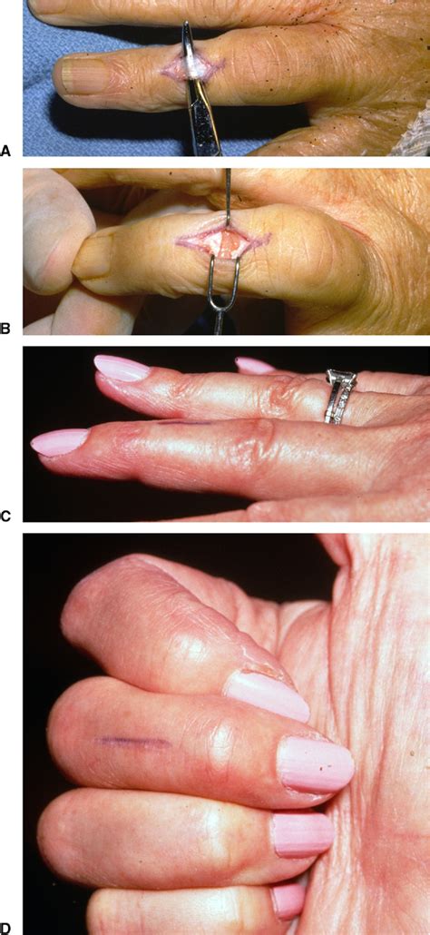Figure 4 from Treatment of boutonniere finger deformity in rheumatoid ...