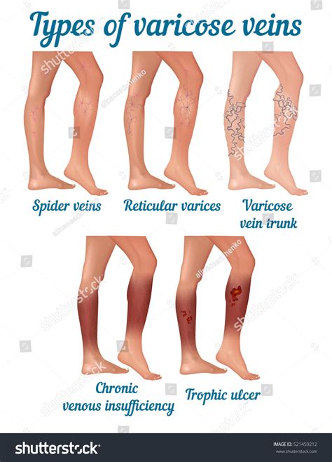 Types Varicose Veins Types Varicose Disease: เวกเตอร์สต็อก (ปลอดค่า ...