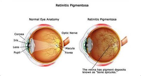Treating blindness with gene therapy might be possible, says new study ...