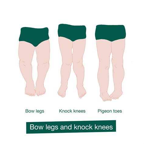 What To Do About Bow Legged Baby at Nicole Webber blog