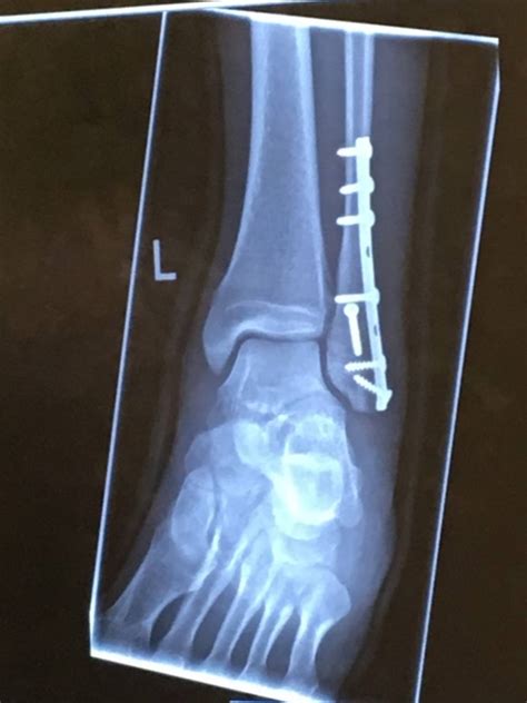 Broken Ankle- ORIF Surgery what