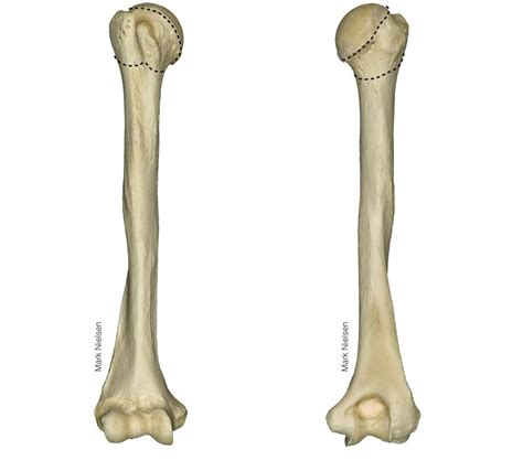 Image result for Sulcus Sign Grading