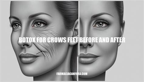 Botox for Crow's Feet: Before and After Results