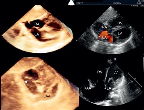 Left Atrial Appendage Aneurysm and Atrial Septal Defect | Revista ...