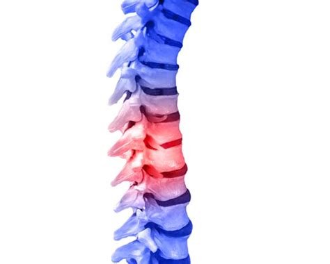 Image result for Nerve Root Block Lower Back