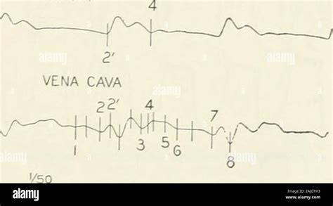 Image result for Myogram