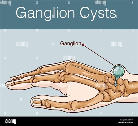 Ganglion Cyst On Finger Stock Photo Image Of Cyst