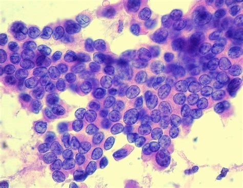 orphan annie nuclei in papillary thyroid carcinoma - Brainly.in