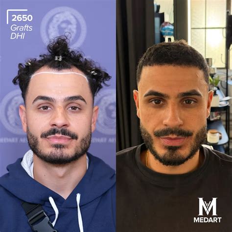 All-Inclusive Turkey Hair Transplant Package with MedArt - Medart Hair