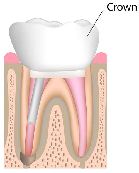 Root Canal Crown Front Tooth
