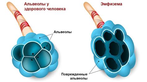 Хроническая обструктивная болезнь легких (ХОБЛ): симптомы, лечение, степени