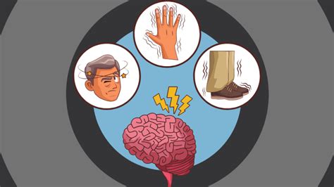 Stem Cell Therapy May Help Treat And Slow Down Parkinson’s Disease ...