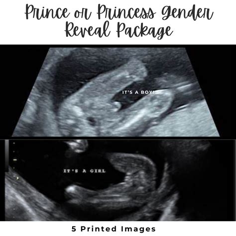 15 Weeks Pregnant Ultrasound 2024