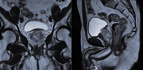 Prostate Cancer Awareness