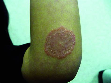 Ringworm, tinea, causes, signs, symptoms, diagnosis & treatment - how small is ringworm