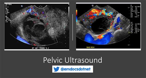 Uterus Ultrasound Transvaginal