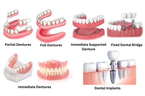 Image result for Different Types Dentures