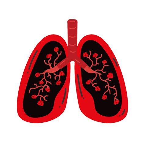 Lung Cancer Detection System based on CNN