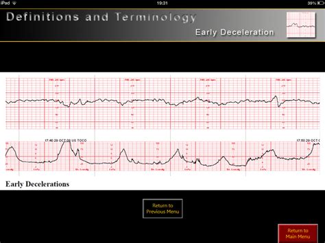 Fetal Heart Tracing Categories