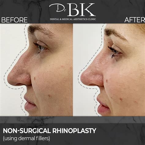 Non-Surgical Rhinoplasty | DrBK Aesthetics Clinic Berkshire