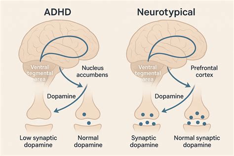 ADHD Brain vs. Normal Brain: What's Different and Why It Matters – Graymatter Labs