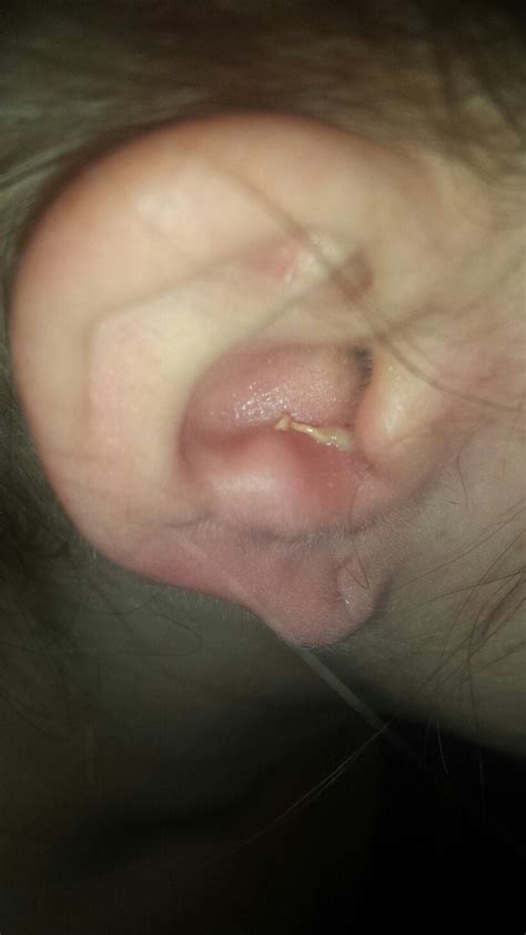 Image result for Loud Exploding Zit