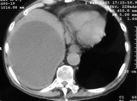 Bildergebnis für ruptured abscess on colon