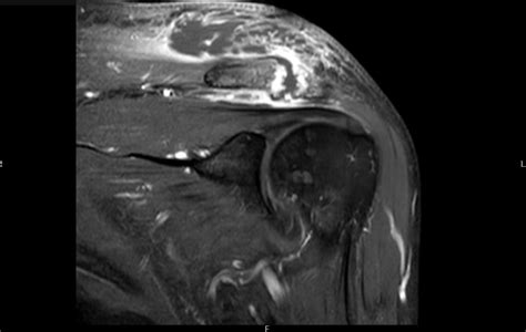Septic Arthritis of the Acromioclavicular Joint: A Case Report - JETem