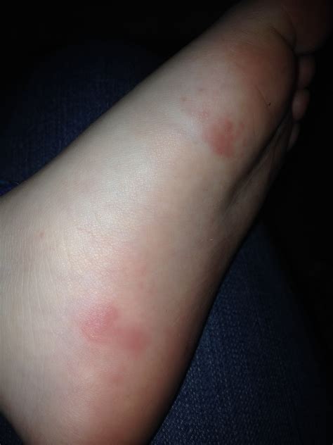 Painless Red Spot On Bottom Of Foot Online | emergencydentistry.com