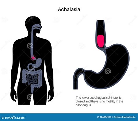Esophageal Achalasia Disease Stock Vector - Illustration of junction, stomach: 286804909