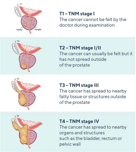 Stages of Prostate Cancer | PCFA