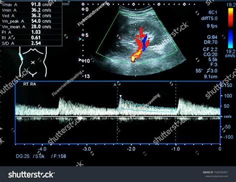 Doppler Ultrasound Imaging Renal Artery Kidney Stock Photo (Edit Now) 1543702931
