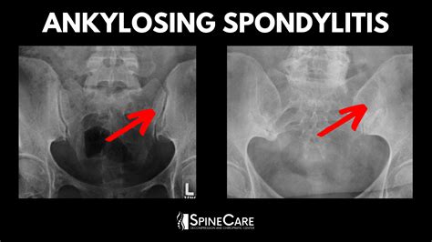 Sacroiliac Joint Pain