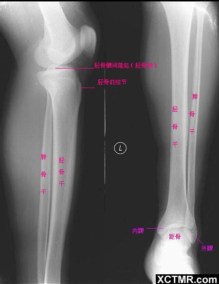 胫骨粗隆 的图像结果