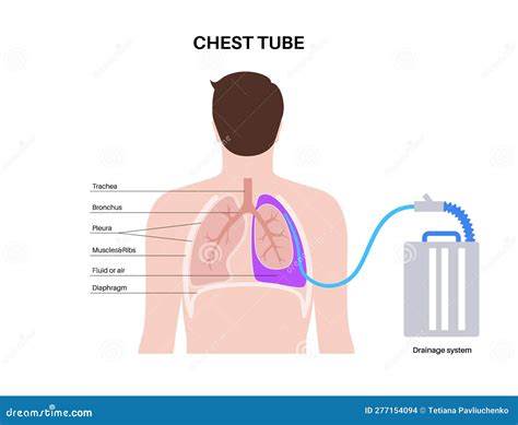 Chest Tube Drainage System