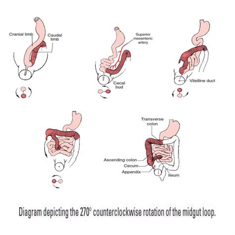 Appendicitis | PPTX