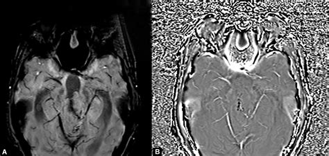 Unusual Presentation of Central Neurocytoma in Posterior Part of Third ...