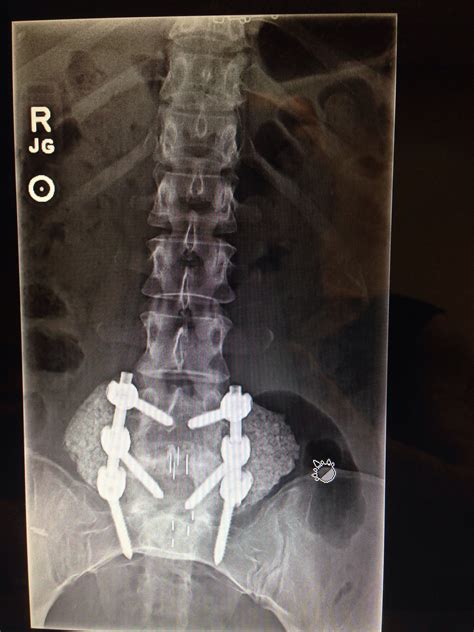 Pin on Spinal fusion surgery