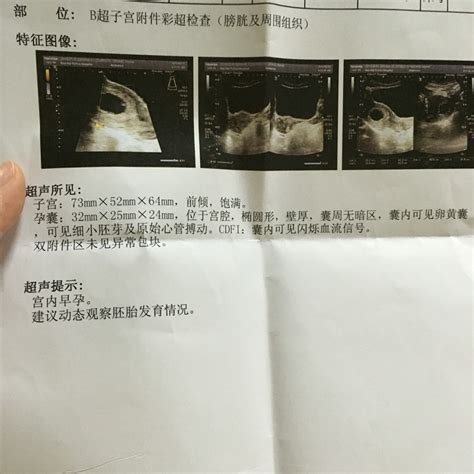 染色体异常导致胎停前往泰国做第三代试管婴儿成功生下健康儿子-莱婴健康